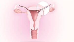 essure
